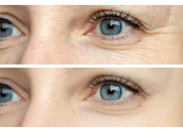 Гусиные лапки вокруг глаз: Причины появления и как их избавиться