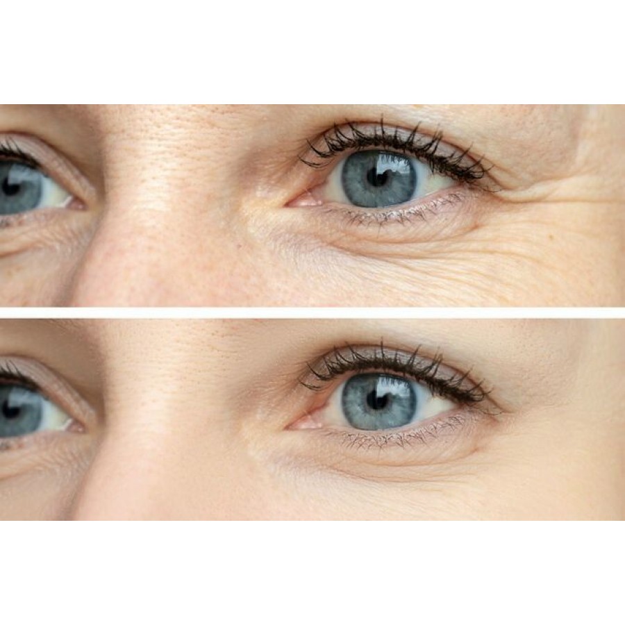 Wrinkles around the eyes: Causes and how to get rid of them